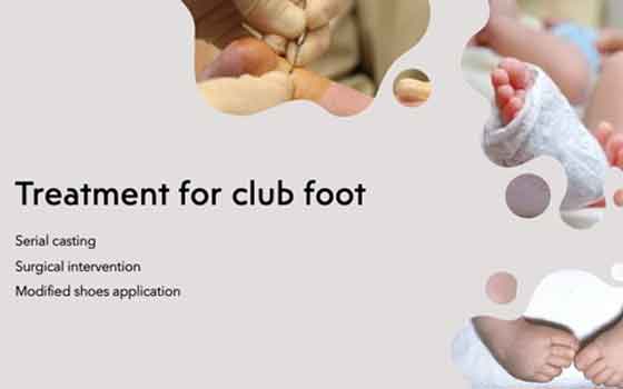 treatmentclubfoot