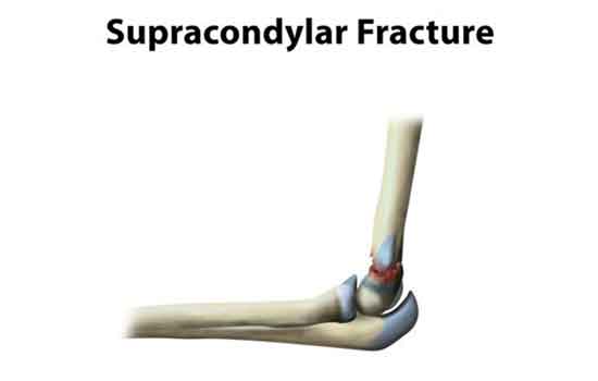 supracondylar fracture